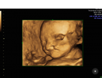 Cleft lip 3D profile